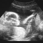 Bill could lead to more ultrasounds, fewer abortions