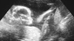 Oral arguments heard in fetal heartbeat lawsuit in Iowa